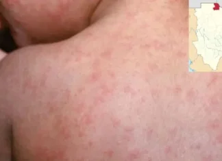 Registra Chihuahua 95% de casos de sarampión en México