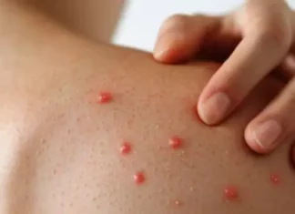 Llega Chihuahua a más de mil casos de sarampión