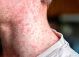 Analiza Consejo Estatal de Salud avance del sarampión en Chihuahua: suman mil 740 casos en 39 municipios