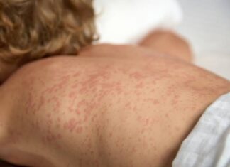 Gobierno de Chihuahua refuerza acciones ante brote de sarampión