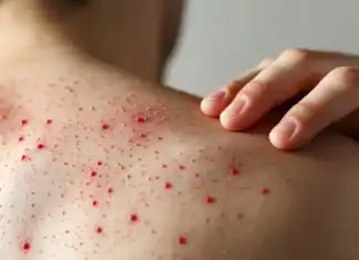 Brote de sarampión en Chihuahua suma casi 4 mil contagios