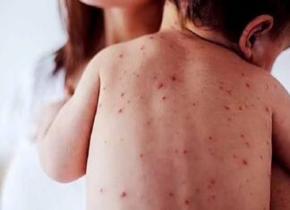 Seguimiento del brote de sarampión en Chihuahua